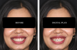 Braces Planning