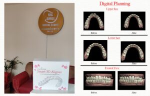 Aligners