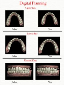 Aligners