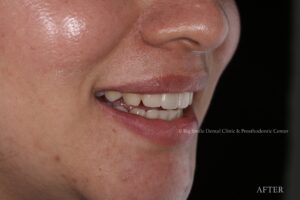 Temporary smile lateral 2