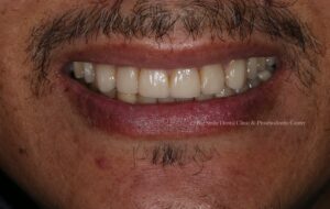 After Veneers