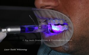 Laser Teeth Whitening