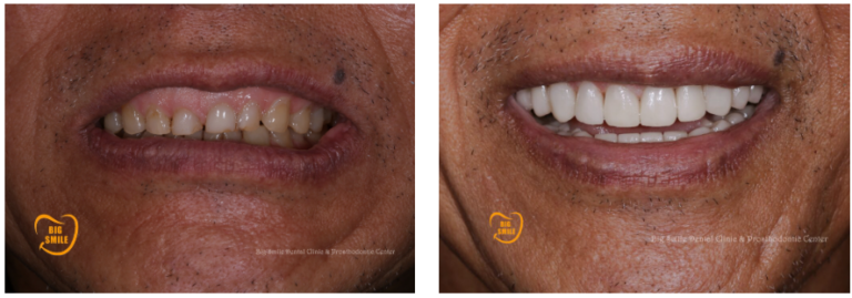 Veneer Before and After