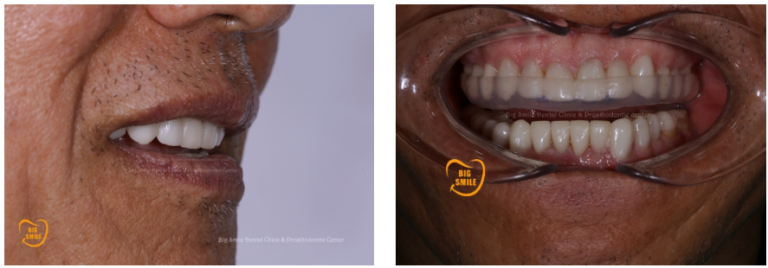 After Smile Transformation