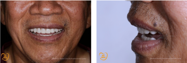Ceramic veneers after treatment