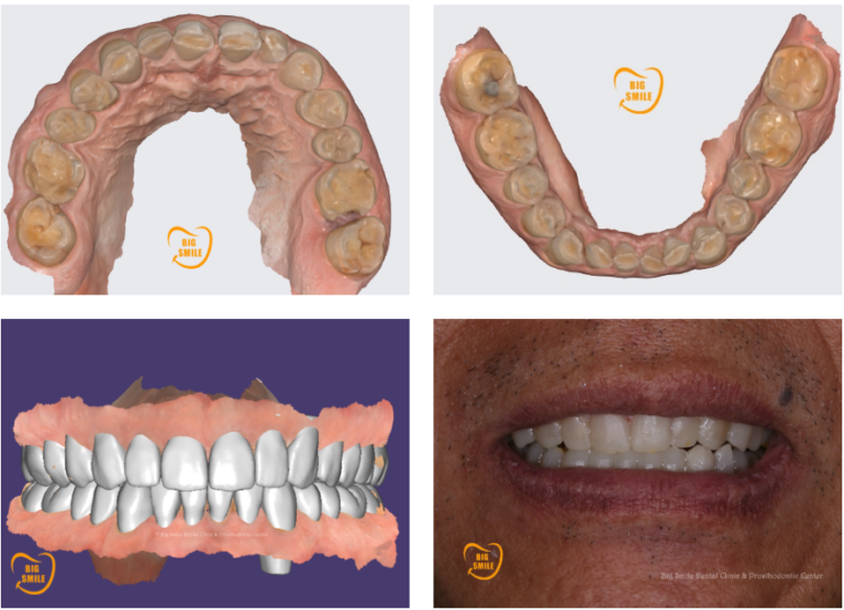 3D smile design