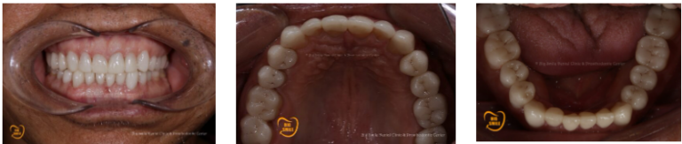 Porcelain Veneers