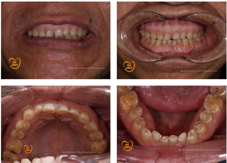 Teeth grinding