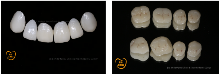 Ceramic veneers