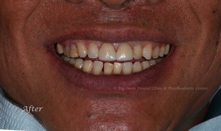 broken-front-tooth-fix-after.jpg