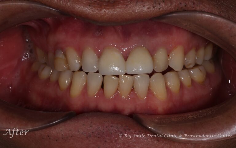 broken-front-tooth-fix-before-after.jpg