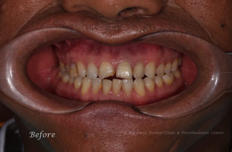 broken-front-tooth-fix-before-after.jpg
