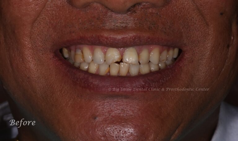 broken-front-tooth-fix-before.jpg