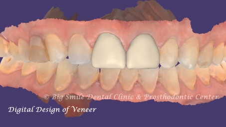 broken-front-tooth-fix-before-after.jpg